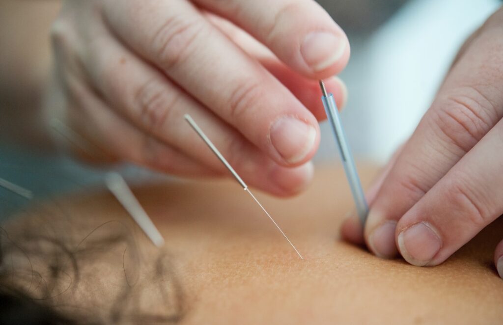 Acupuncture needles close up